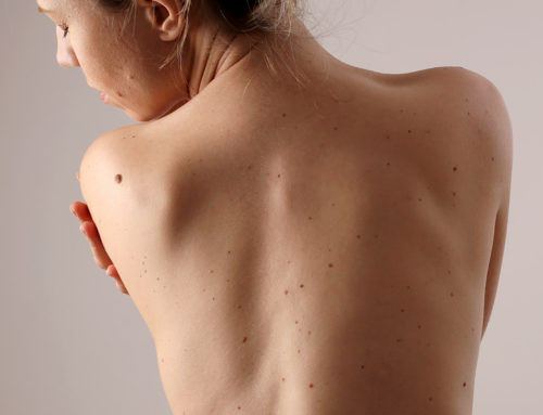 Les Symptomes Des Staphylocoques Et Staphylocoques Dores