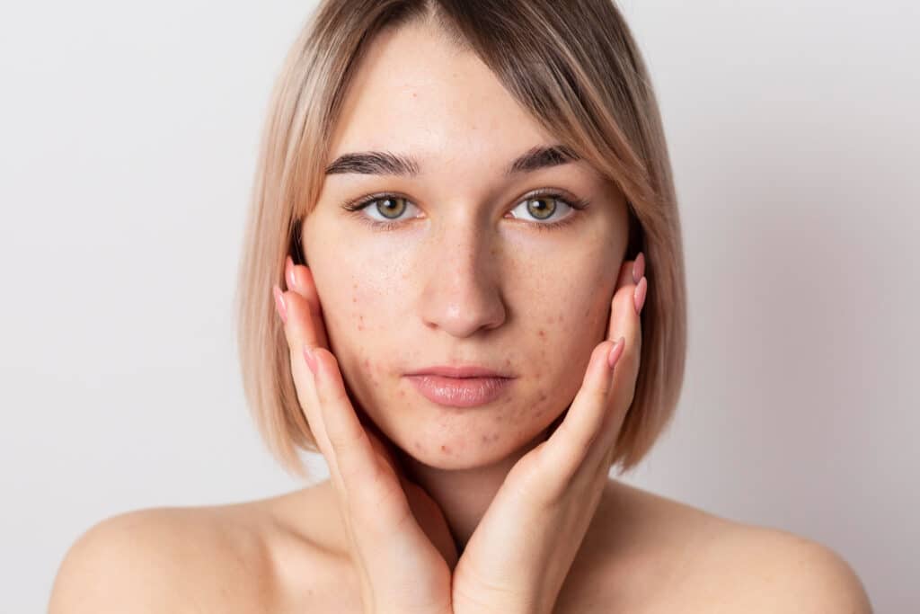 Acné et été : comment éviter la poussée d'acné post-soleil